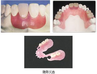隱形義(yi) 齒價(jia) 格