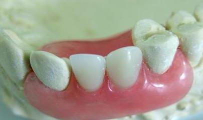 隱形義(yi) 齒費用