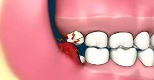 智齒冠周炎怎麽(me) 辦