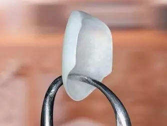 牙齒貼麵的製作過程
