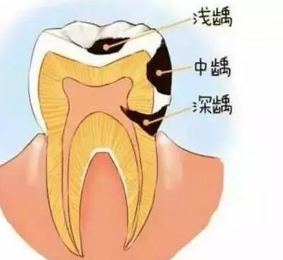 補牙拍片的原因