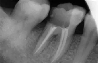 補牙拍片的重要性