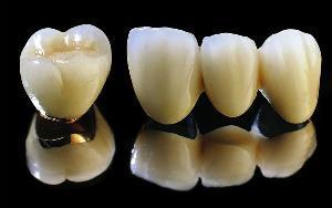 普通烤瓷牙價(jia) 格表