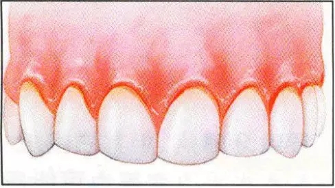 如何自我檢查牙齦炎