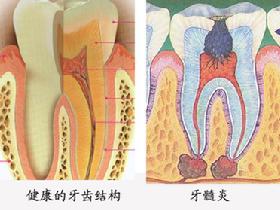 牙髓炎會(hui) 不會(hui) 自己好