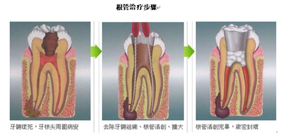 牙髓炎根管治療