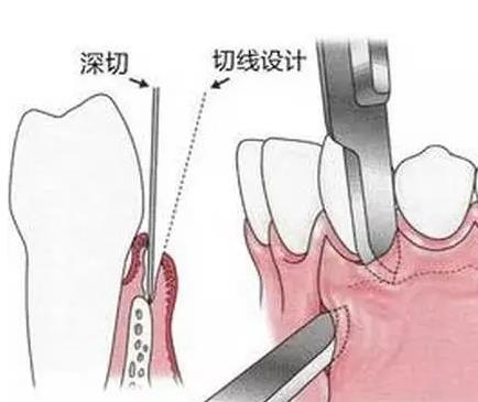 拔牙的基本步驟