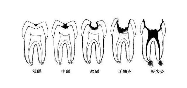 牙齒壞到什麽(me) 程度要拔出