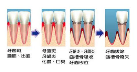 牙齒什麽(me) 時候要拔牙