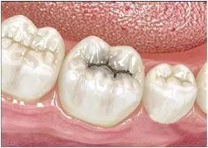 牙齒壞掉的原因