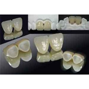 全瓷牙冠不過敏