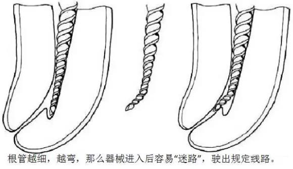 根管治療難不難