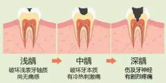 牙齒齲洞填充多少錢