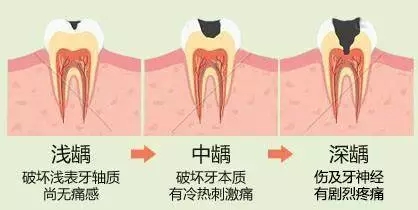牙齒齲洞填充多少錢