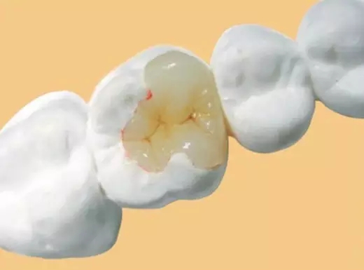 牙齒齲洞填充價(jia) 格