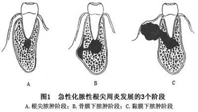 根尖周炎導致的牙齒鬆動
