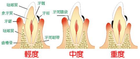 牙周炎導致的牙齒鬆動和牙齦流膿
