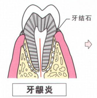 牙齦炎能治愈嗎