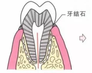 導致牙縫大的原因