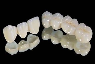 全瓷牙套價(jia) 格