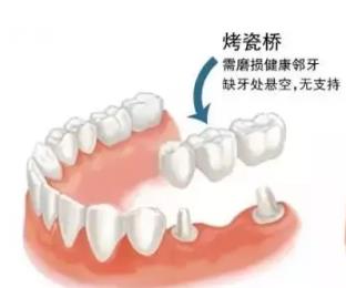 烤瓷牙搭橋多少錢