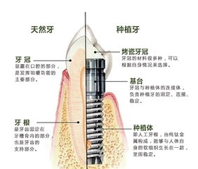 種植牙都有什麽(me) 牌子