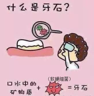 洗牙去除牙結石