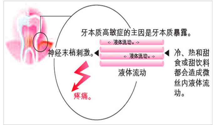 牙本質過敏是什麽(me) 