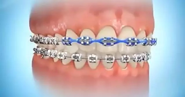 牙齒縫隙大帶牙套矯正結果好嗎