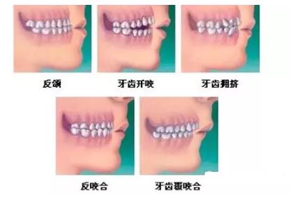 為(wei) 什麽(me) 說牙齒矯正越早越好