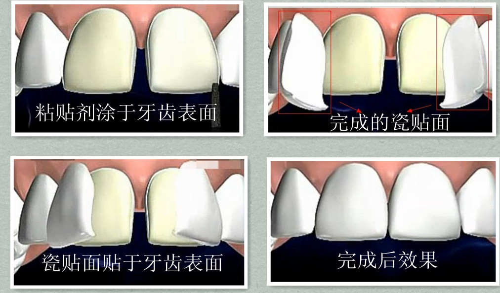 前牙稀疏做貼麵修複好不好