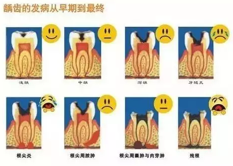 蛀牙不疼了還要補牙嗎