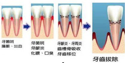 種植牙發炎的原因