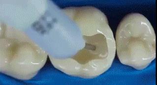 補牙後再次蛀牙