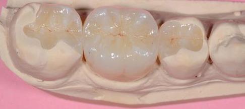 補牙後蛀牙瓷嵌體(ti) 補牙