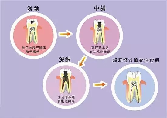 深圳補牙洞多少錢