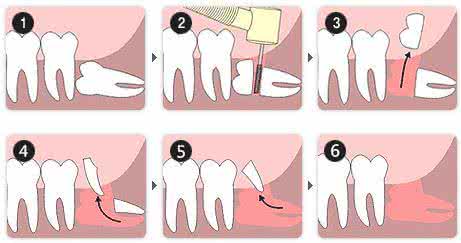 拔牙前注意事項