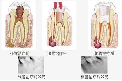 根管治療要幾次才能完成