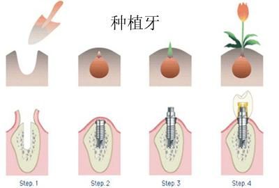 種牙齒多少錢一顆