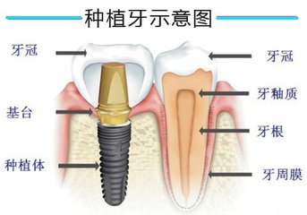 種牙齒的費用組成