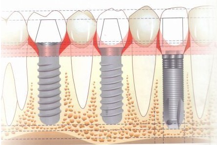 種植一顆牙價(jia) 格