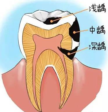 兒(er) 童蛀牙的發展