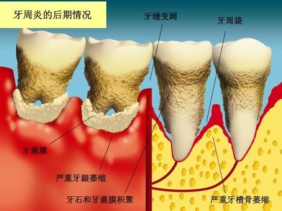 青少年牙周炎的危害