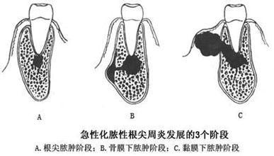 牙槽膿腫治療方法