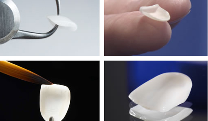 牙齒美白貼片費用