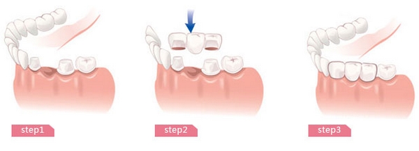 成人烤瓷牙價(jia) 格