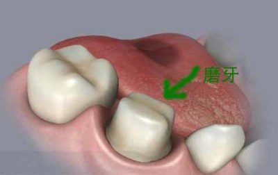 牙齒磨小套假牙好嗎