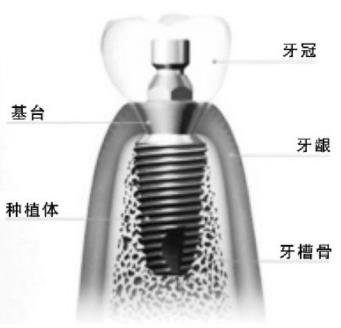 去香港種牙好嗎
