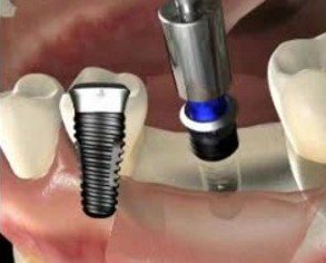 布吉醫院種植牙多少錢