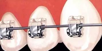 自鎖托槽矯正多少錢